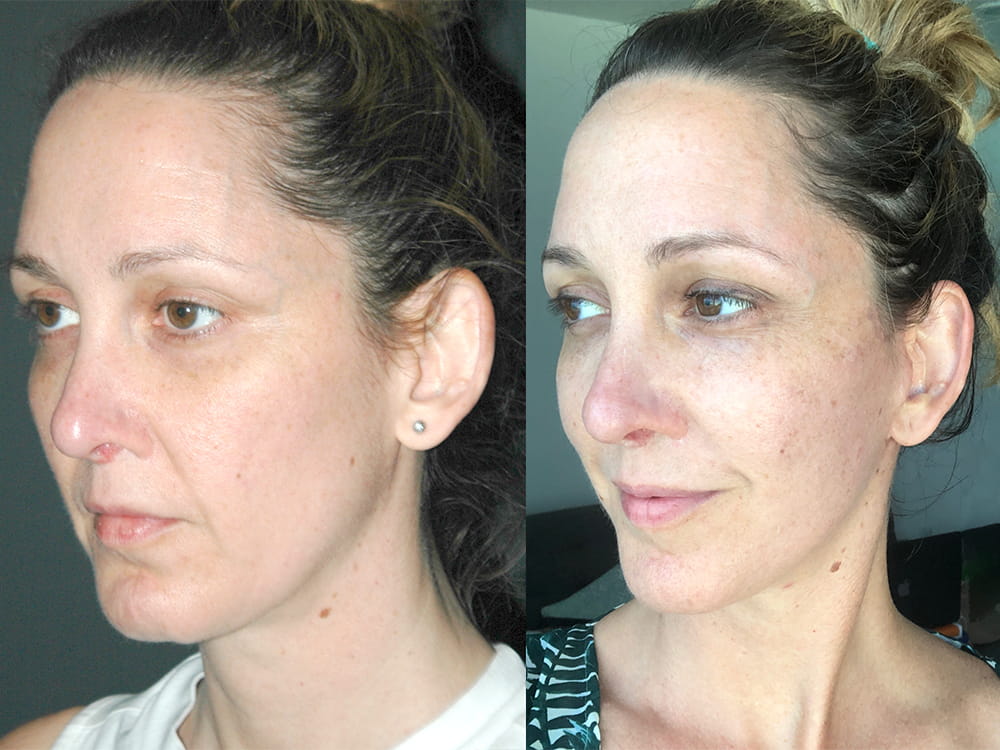 Micro-Mini Lift®: Shorter Recovery Time Than a Facelift