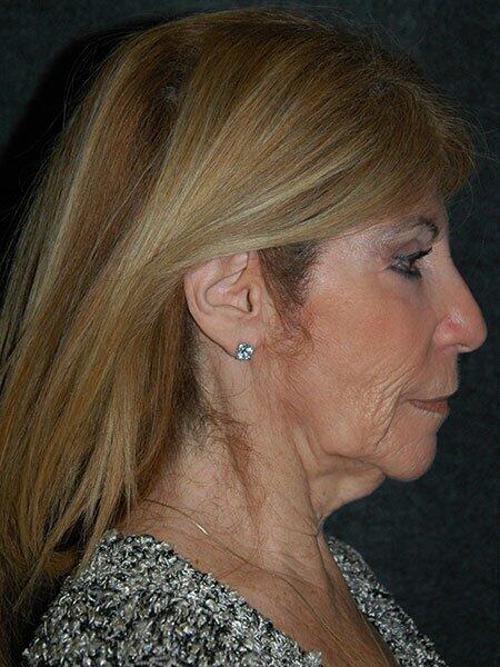 Facelift & Neck Lift Before & After Photo