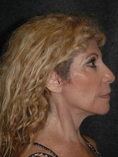 Facelift & Neck Lift Before & After Photo