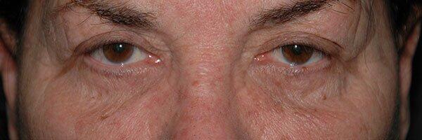 Blepharoplasty Before & After Photo