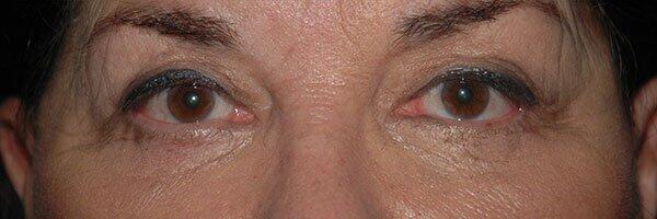 Blepharoplasty Before & After Photo